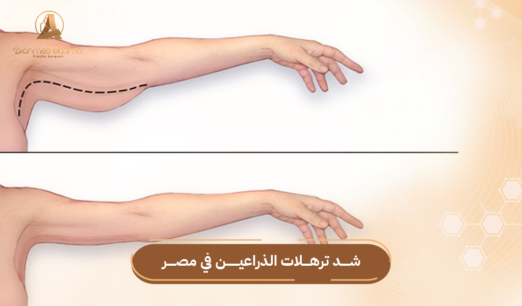 شد ترهلات الذراعين