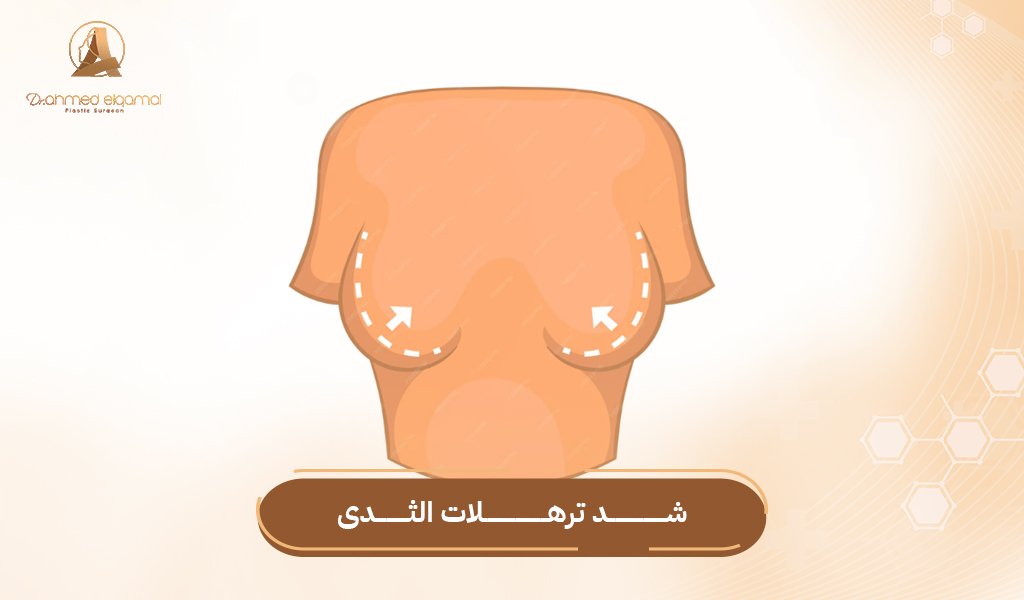 علاج ترهلات الثدى