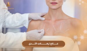 علاج ترهلات الثدى