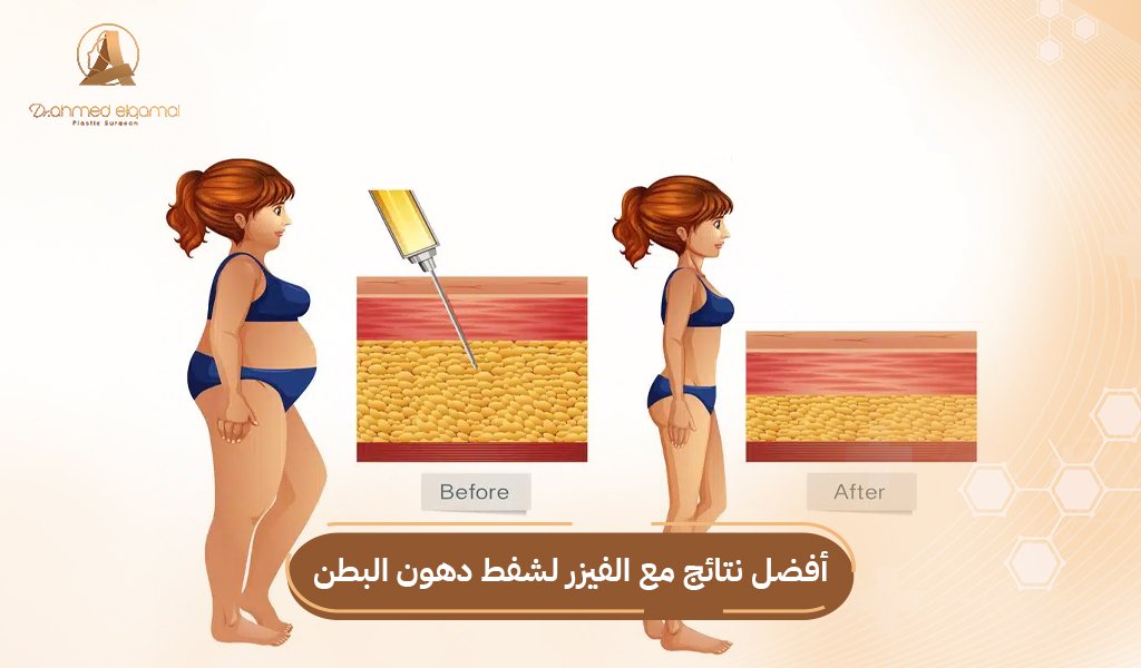 الفيزر لشفط دهون البطن