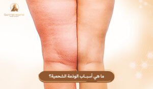 أسباب الوذمة الشحمية