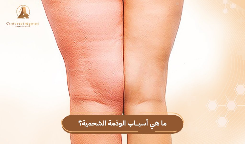 أسباب الوذمة الشحمية