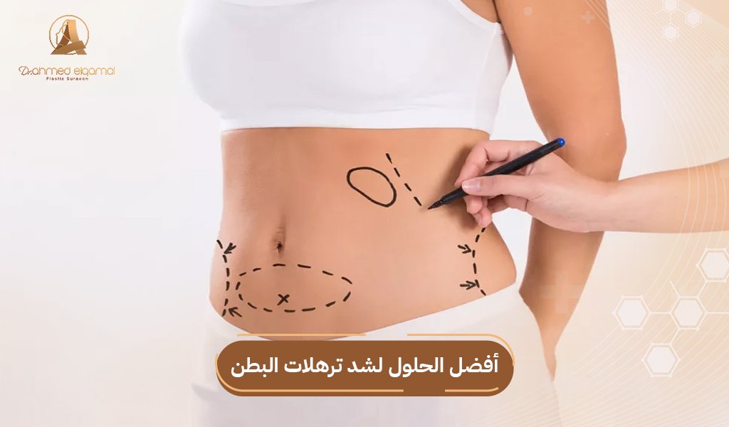 شد ترهلات البطن