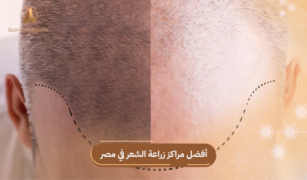 مراكز زراعة الشعر