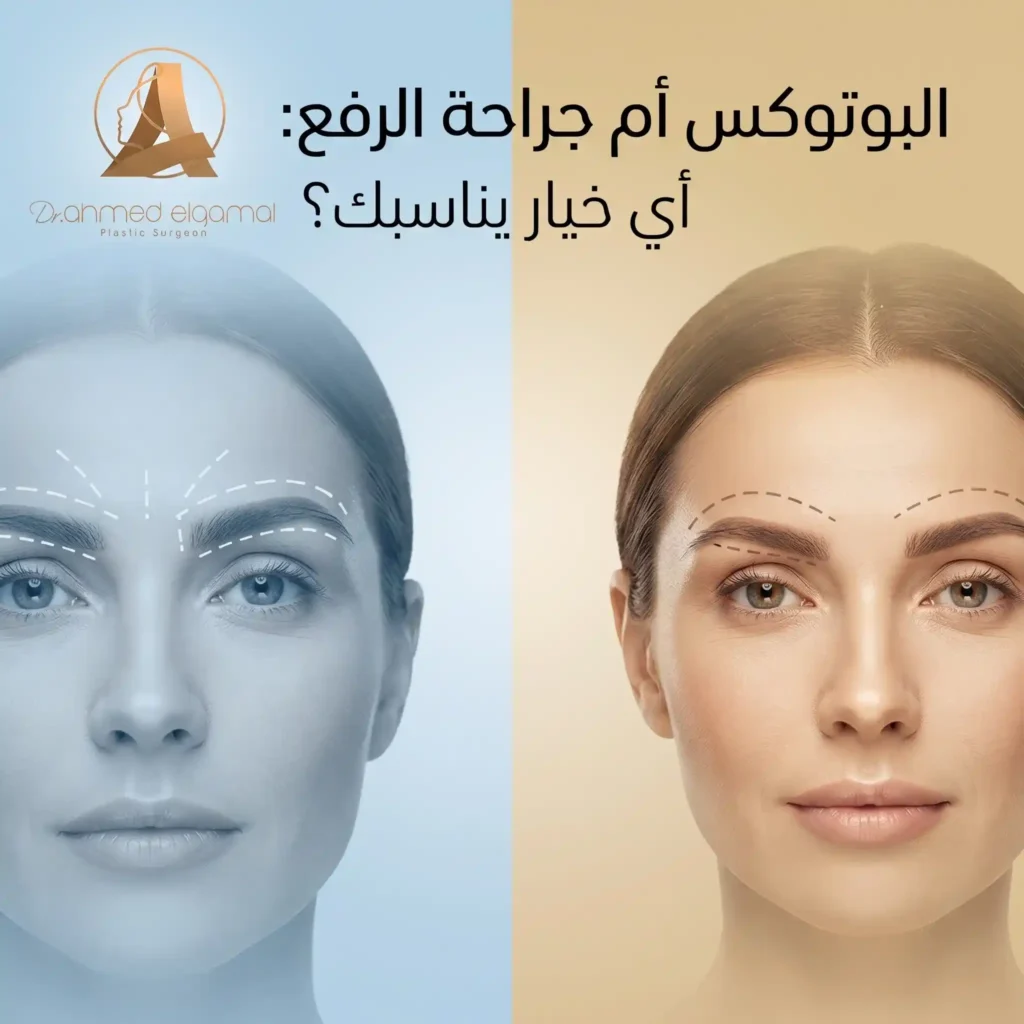 بوتوكس الحواجب