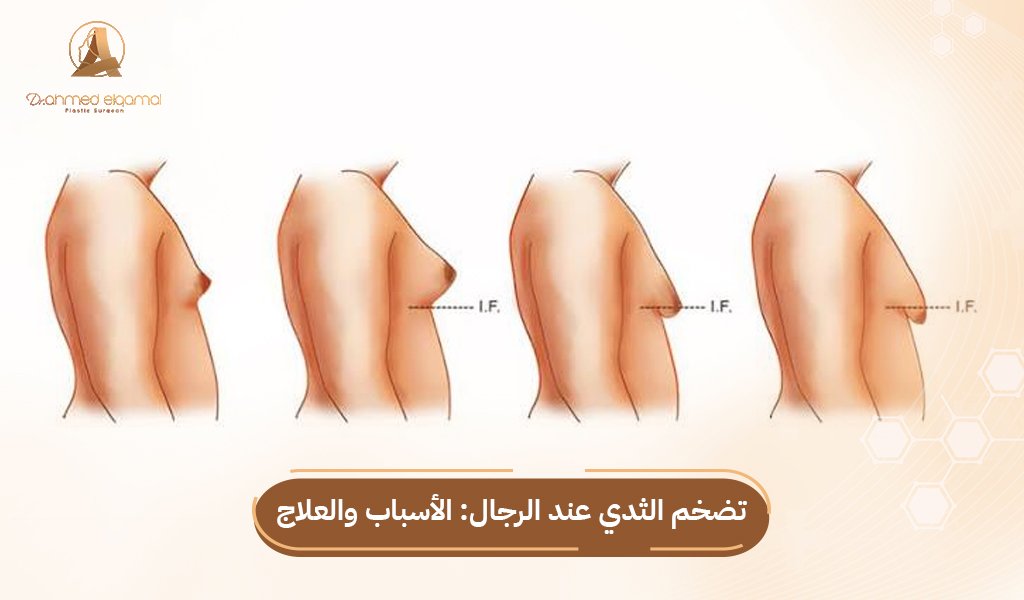 تضخم الثدي عند الرجال