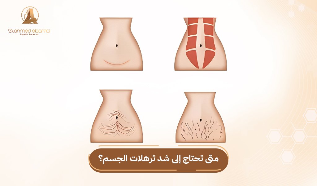 شد ترهلات الجسم