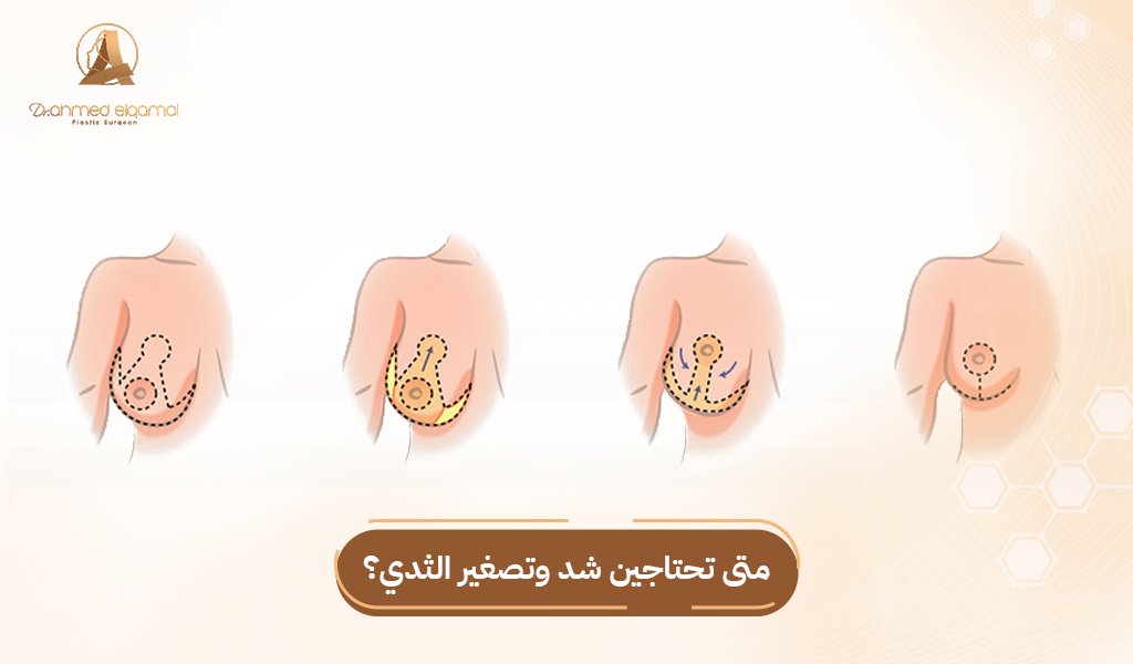 شد وتصغير الثدي