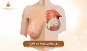 عملية شد الثدي