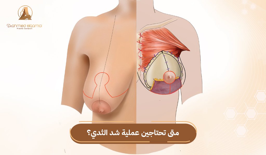 عملية شد الثدي
