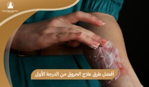 علاج الحروق من الدرجة الأولى