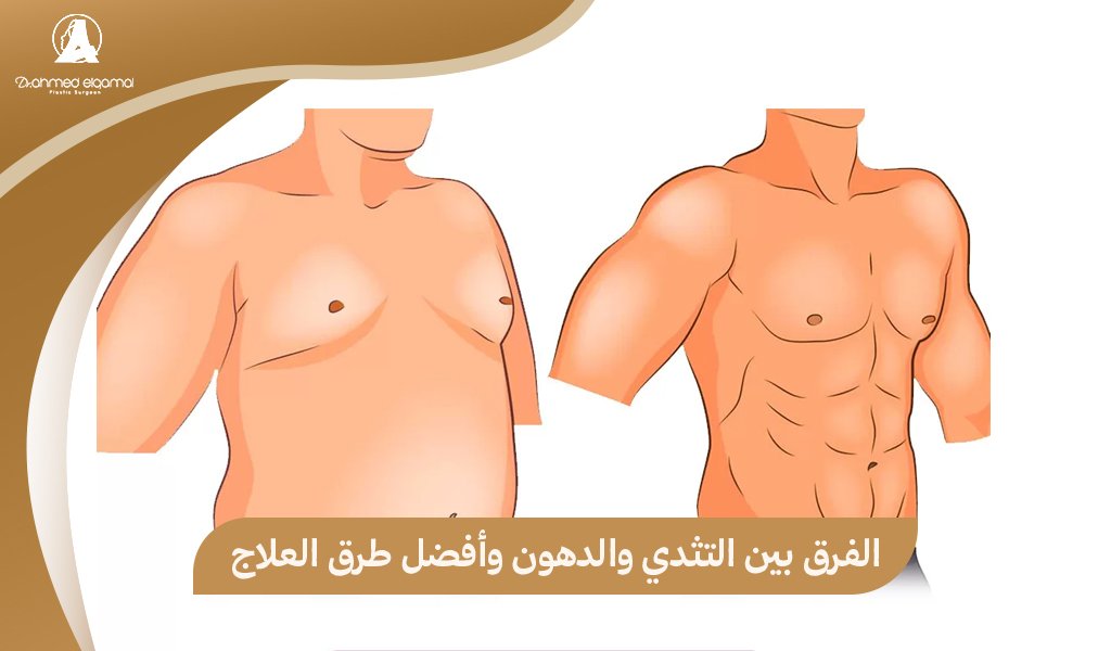 الفرق بين التثدي والدهون