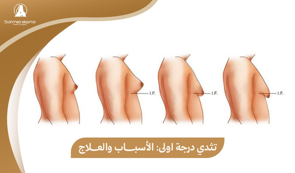 تثدي درجة اولى
