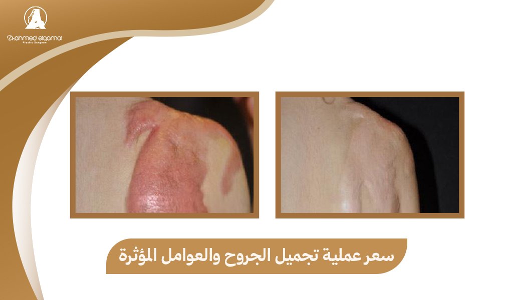 سعر عملية تجميل الجروح